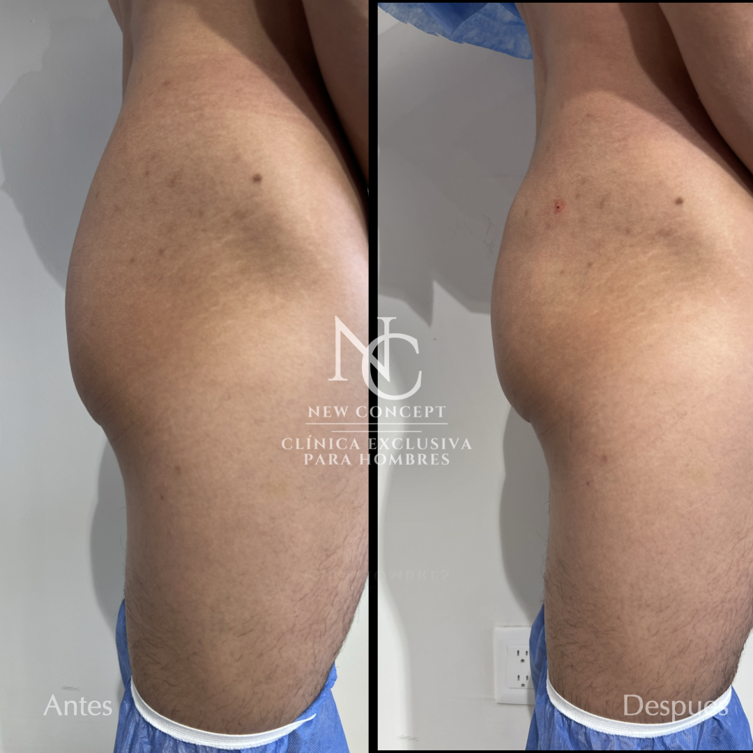 Resultado antes y después — Aumento de Glúteos