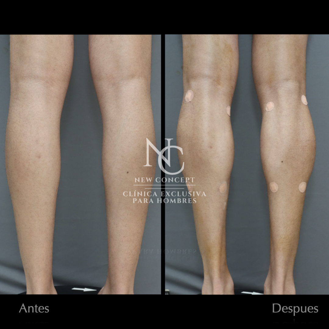 Resultado antes y después — Aumento de Pantorrillas