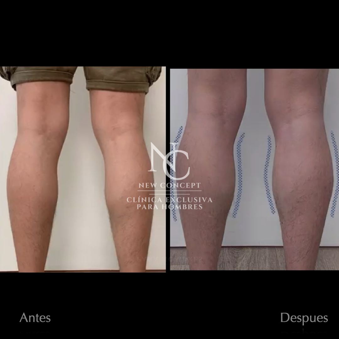 Resultado antes y después — Aumento de Pantorrillas
