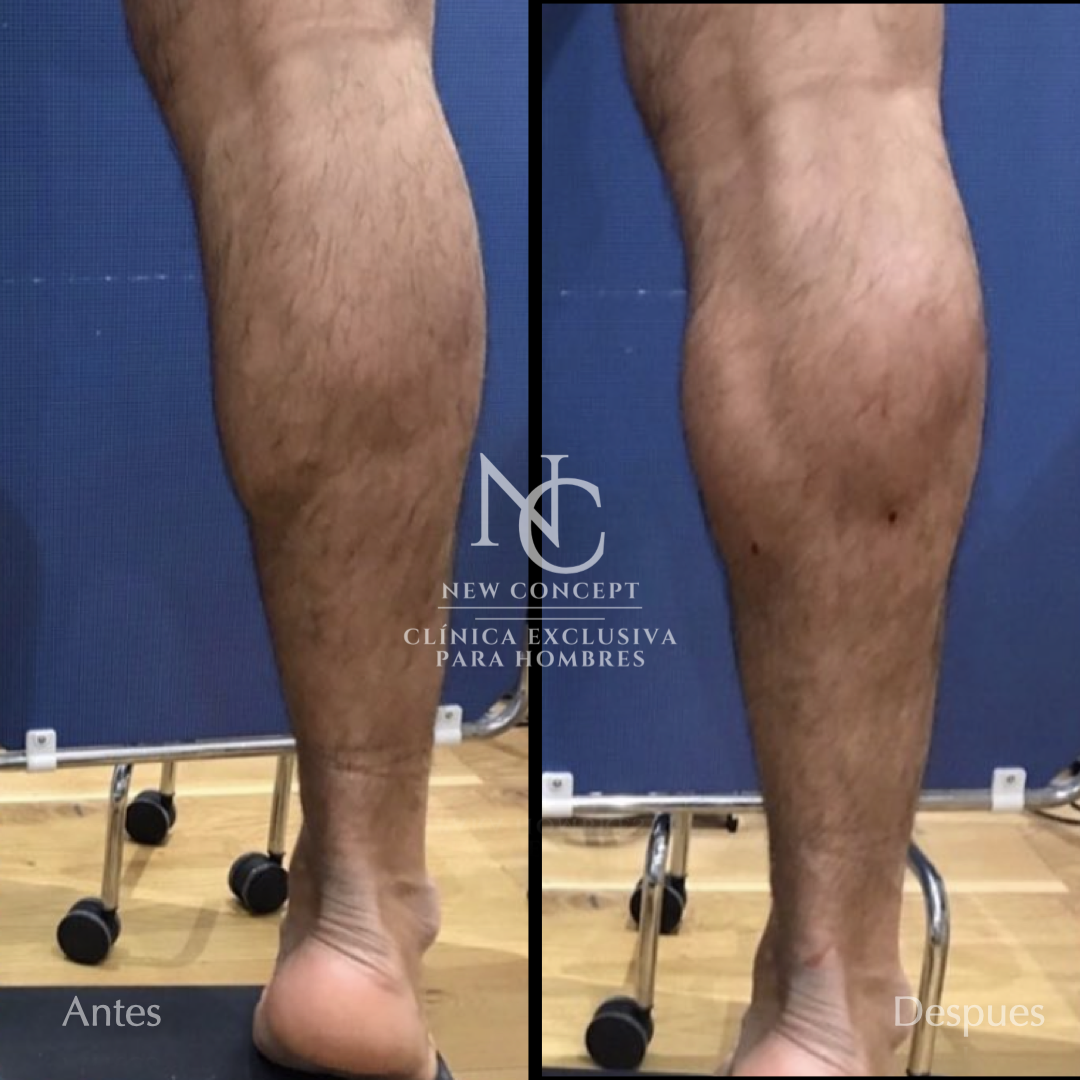 Resultado antes y después — Aumento de Pantorrillas
