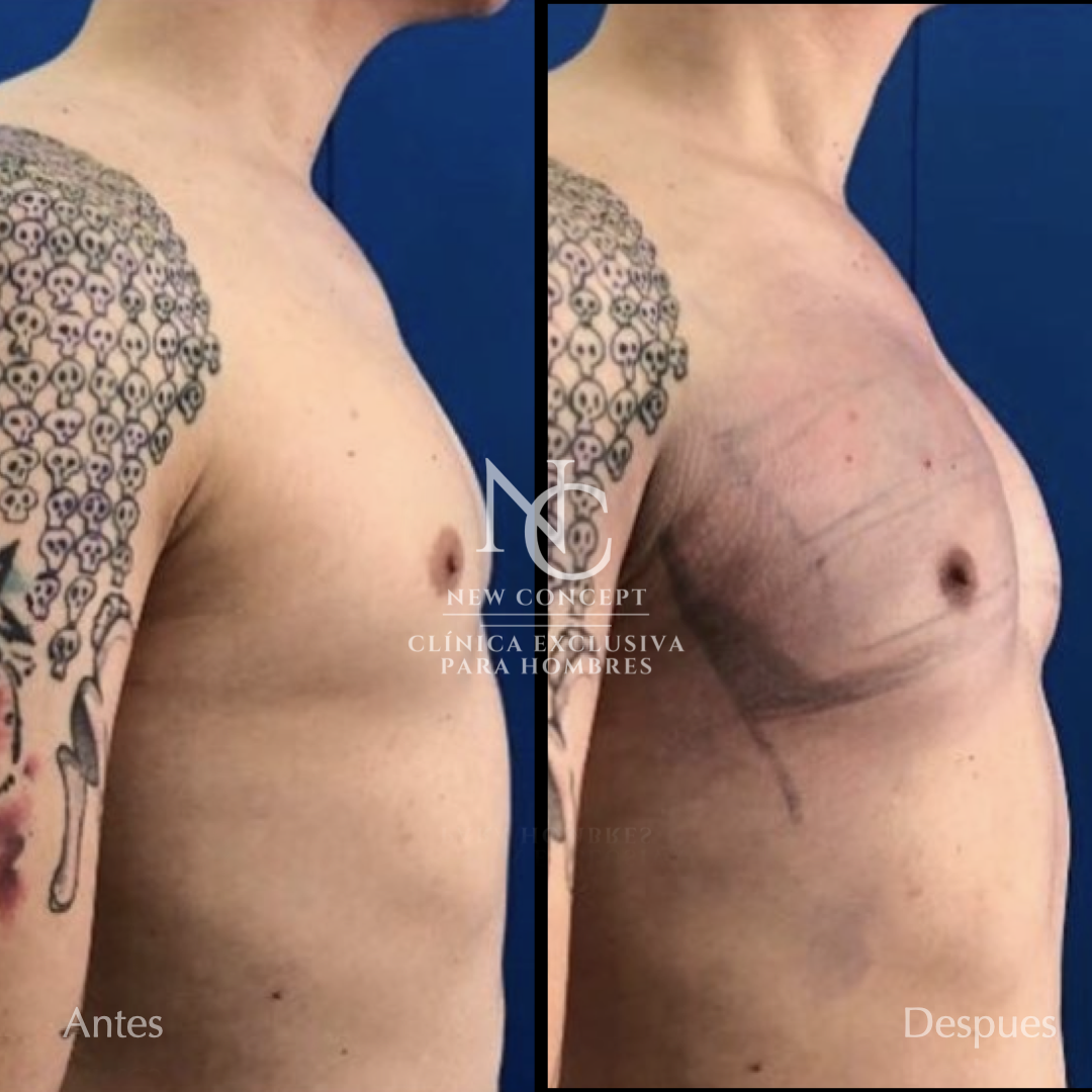 Resultado antes y después — Aumento de Pectorales