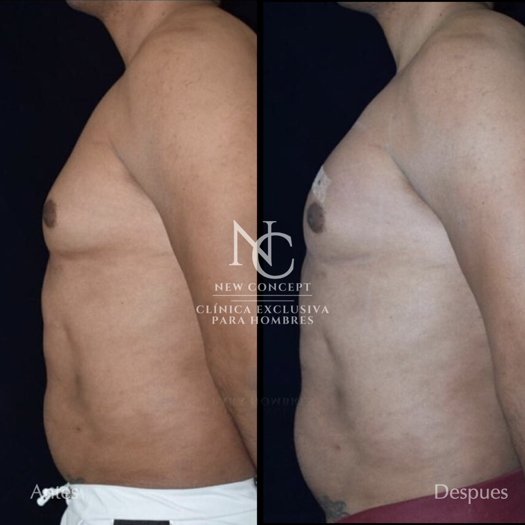 Resultado antes y después — Aumento de Pectorales