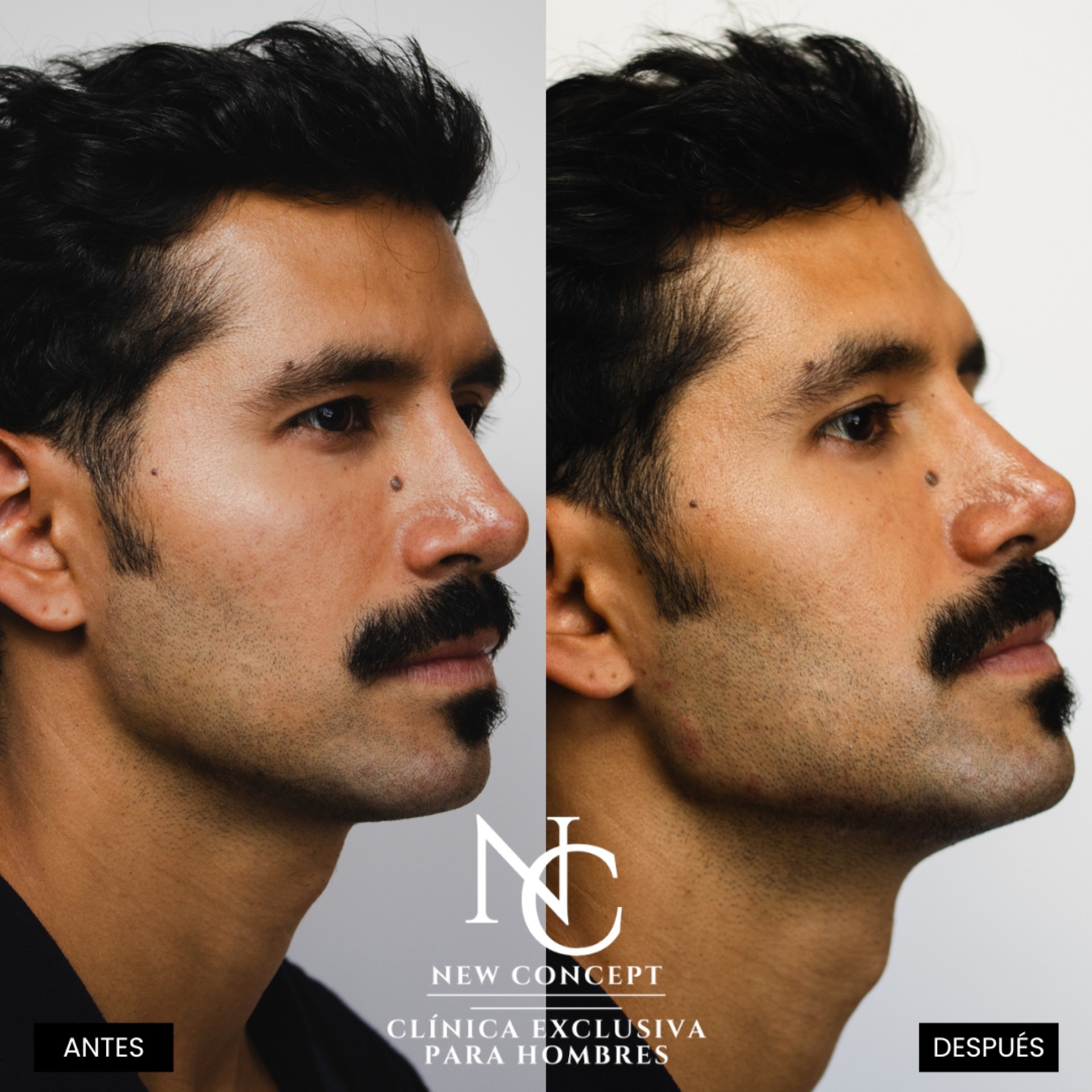 Antes y después — Jawline