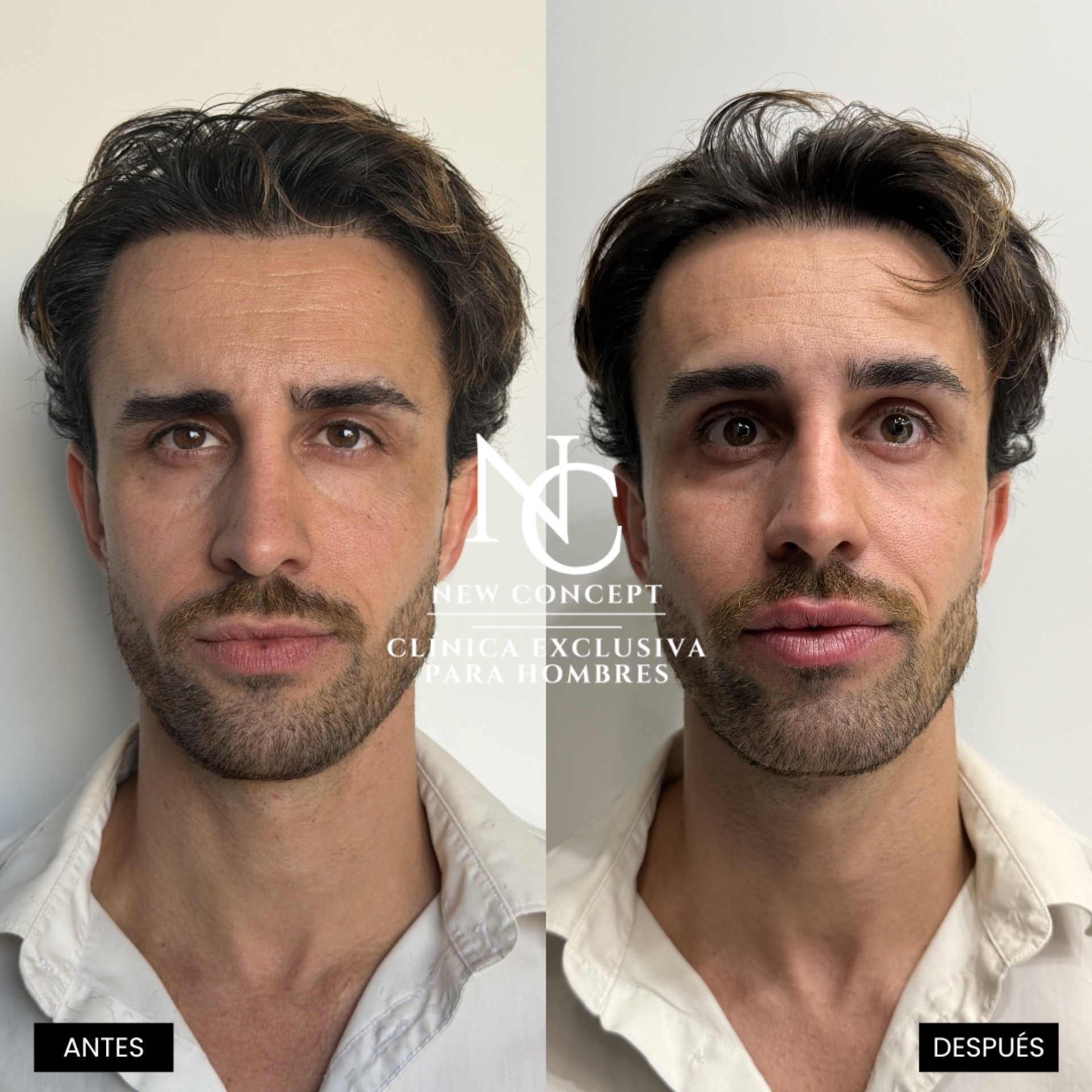 Antes y después — Aumento Labial