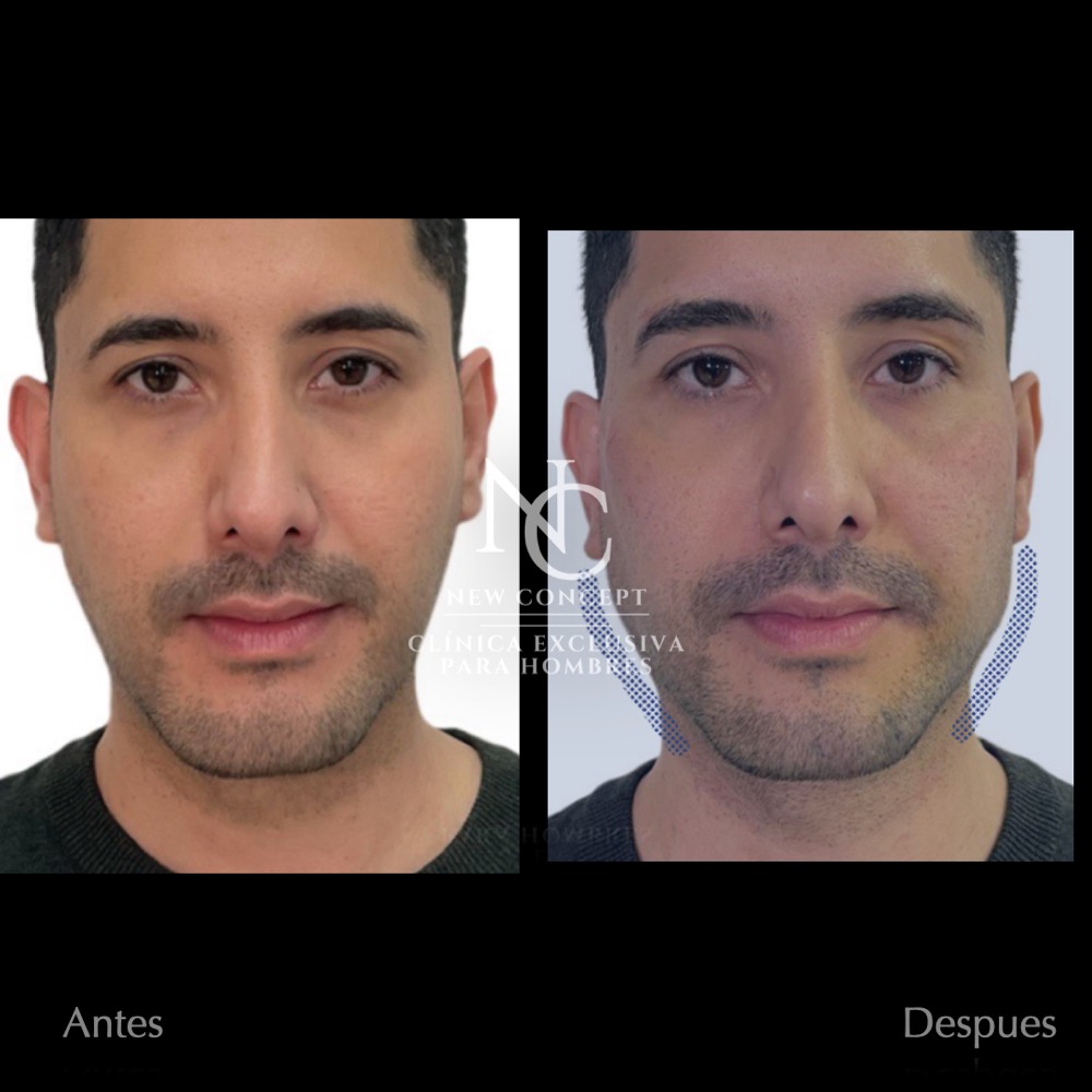 Antes y después — Masculinización Facial