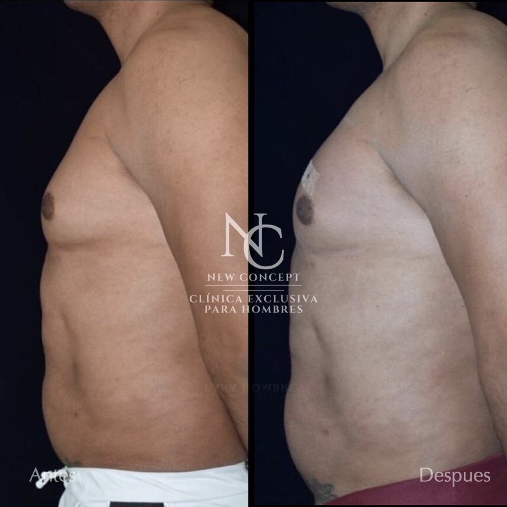 Antes y después — Aumento de Pectorales